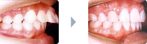 症例3：出っ歯（上顎前突）右側