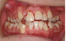 状態の進んだ歯周病