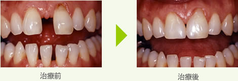 歯のすき間をふさぐ治療例