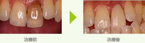 変色した歯を白くコーティング治療例